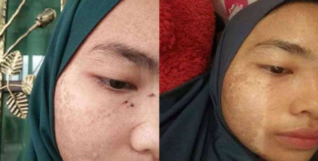 Alih-alih Cantik, Kulit Si Cewek Malah Bersisik Seperti Ular