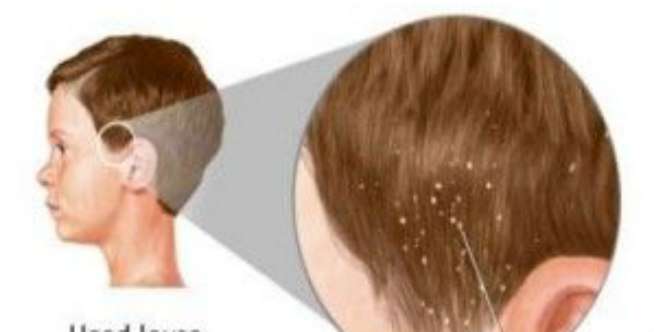 Semprotkan Obat Kumur pada Rambut