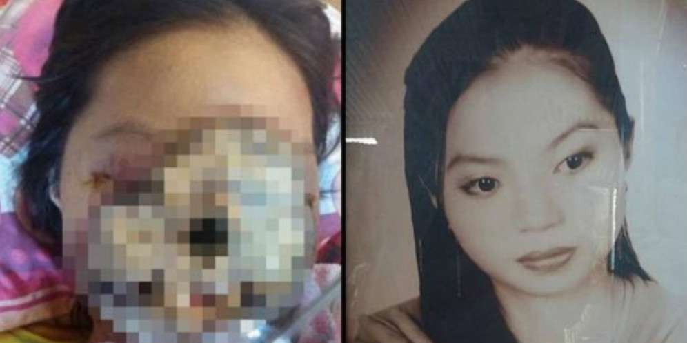 Infeksi Hancurkan Muka