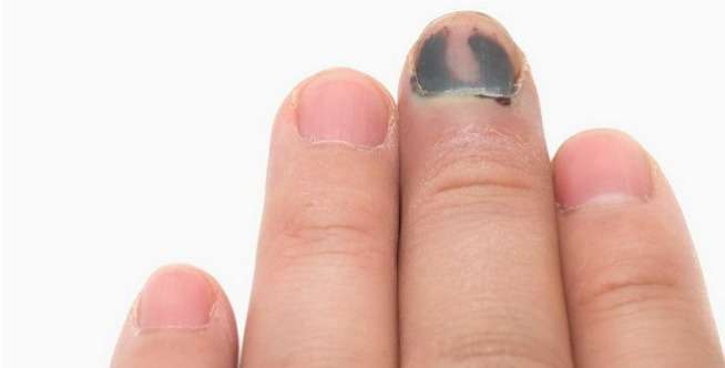 Didiagnosa Menderita Kanker Kulit