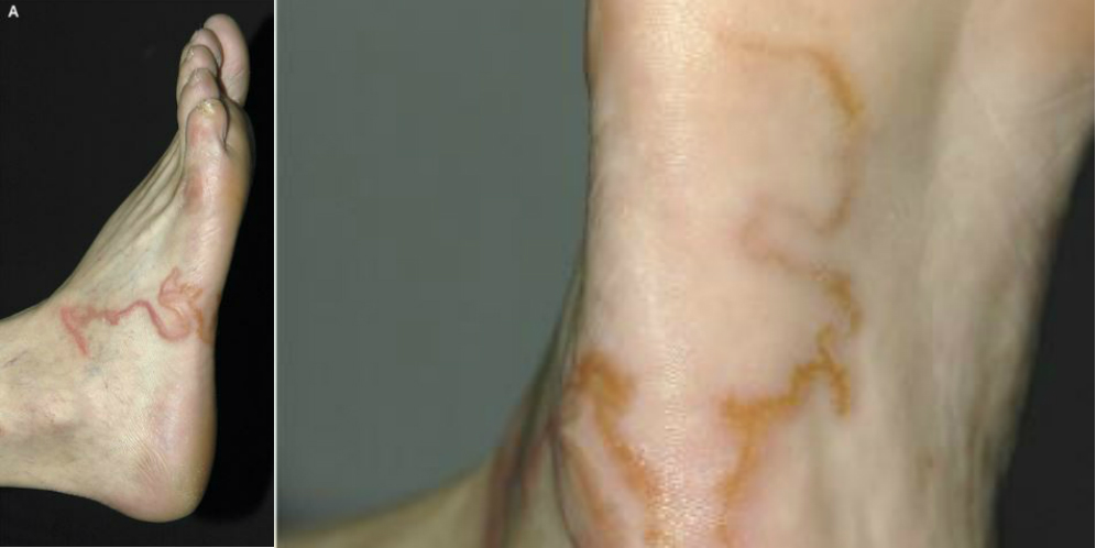 Cacing Masuk Lewat....