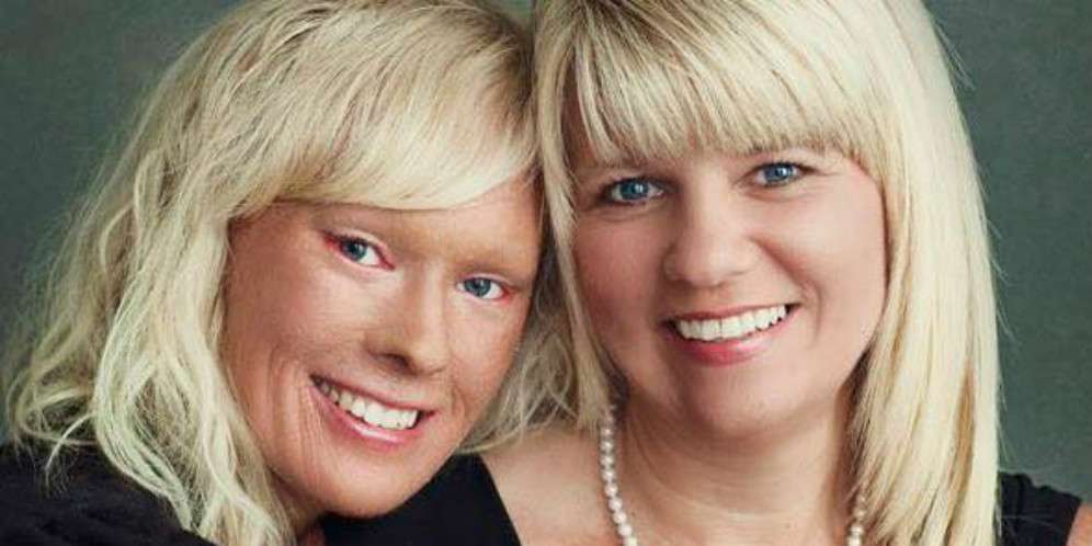 Dulu Diejek, Kini Wanita 'Bersisik' Itu Jadi Ratu Kecantikan