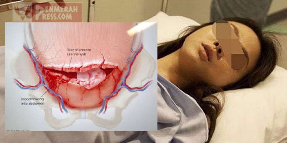 Akibat Hamil Jarak Dekat, Ibu Muda Meninggal Usai Rahim Pecah