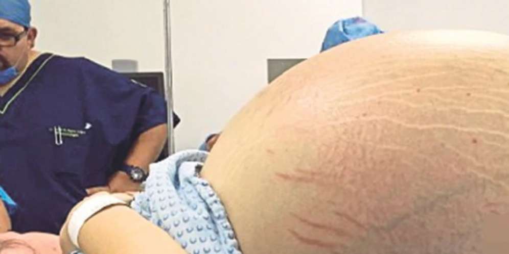 11 Bulan Si Wanita Seperti Hamil 10 Bayi, Setelah Dicek...