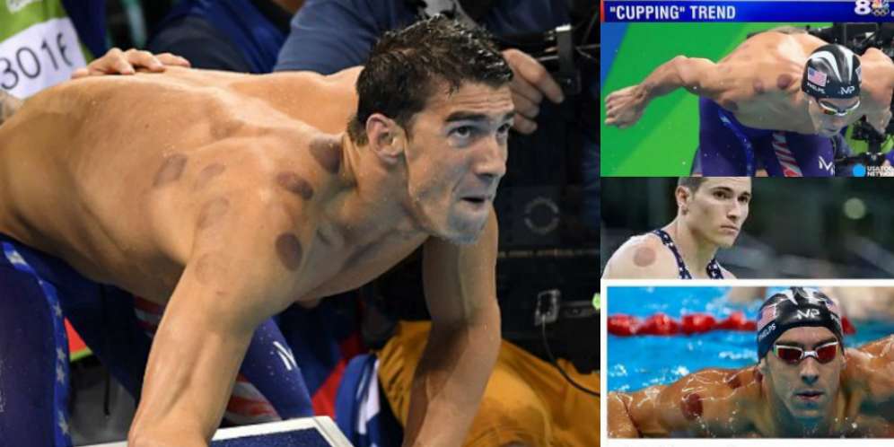 Masya Allah! Teknik Pengobatan Nabi Ditiru Atlet Olimpiade 2016