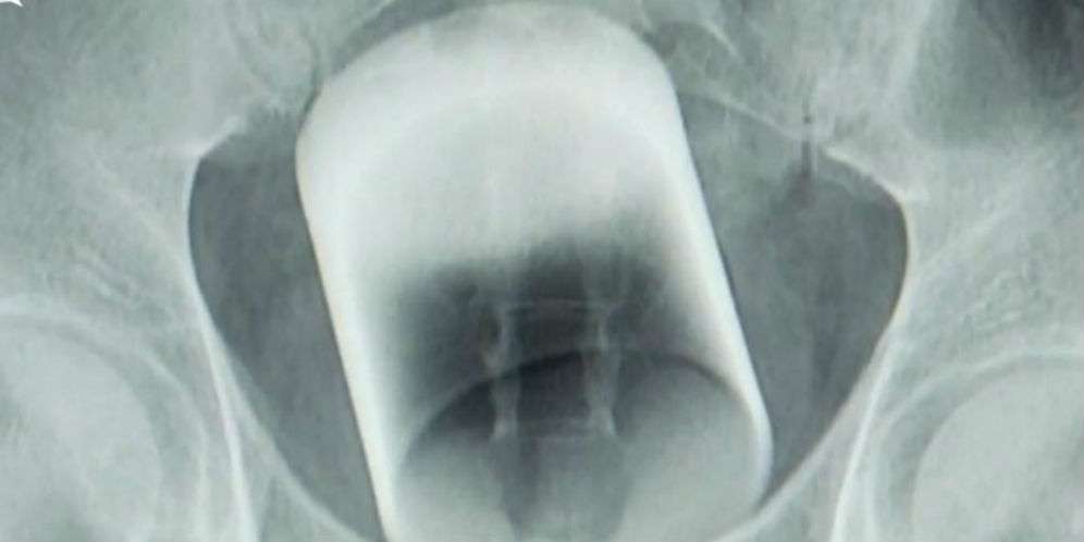 Dikeluarkan Lewat Anus?
