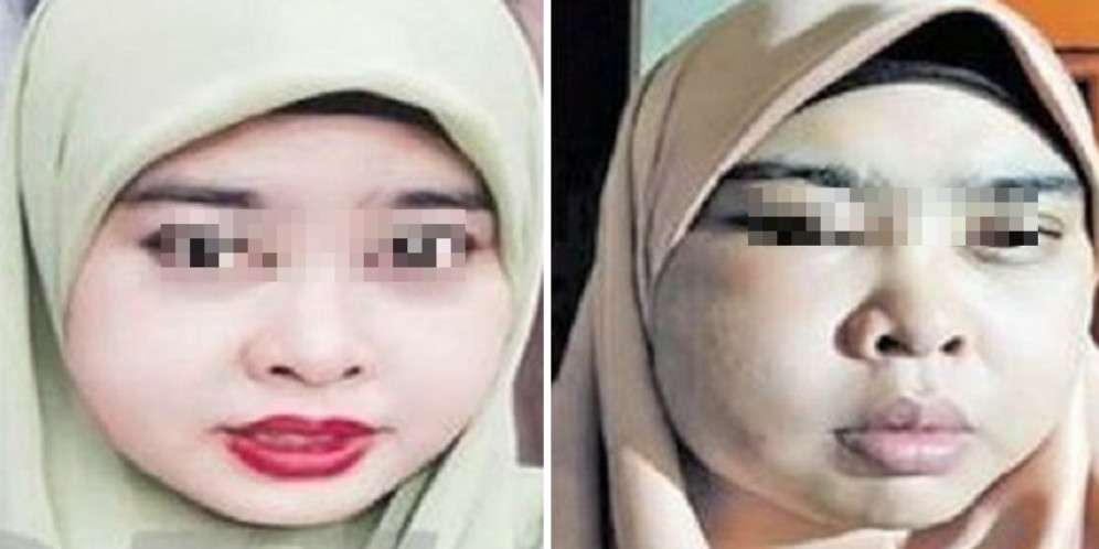 Sakit, Memerah, dan Muka jadi Bengkak