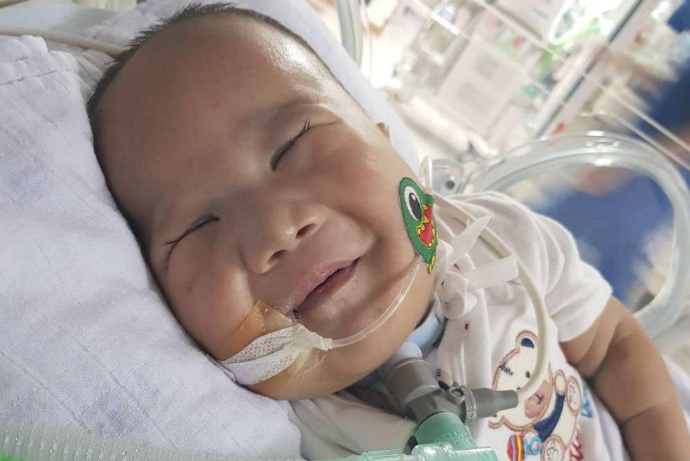 Adam juga memiliki kelainan Patau Syndrome atau Trisomy 13