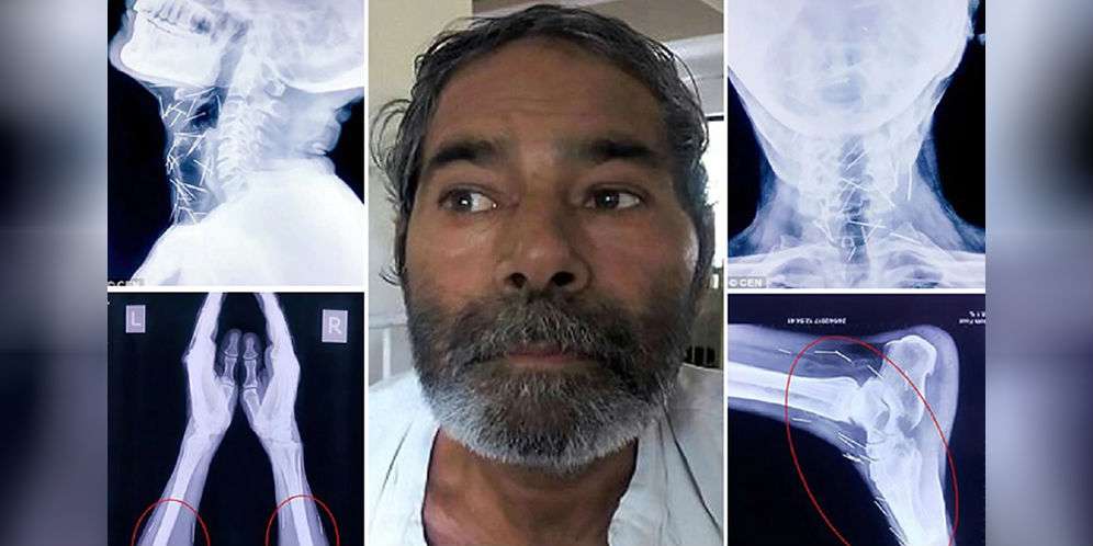 Inikah Korban Santet yang Pernah Ditangani Dokter?