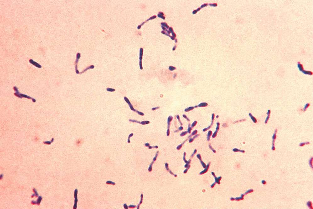 Gejala Khas Penyakit Difteri