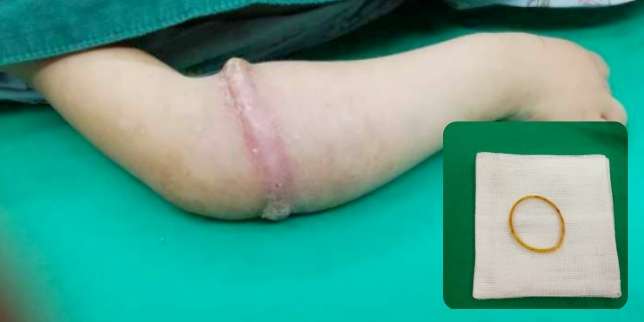 Jangan Pasang Gelang Karet di Anak