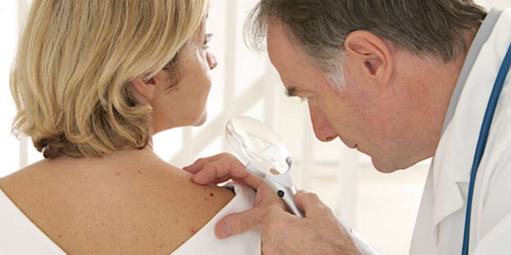 Gejala Kanker Kulit Melanoma