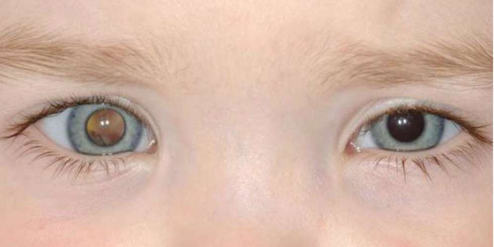 Selain Leukimia, Ini Kanker yang Juga Banyak Menyerang Anak
