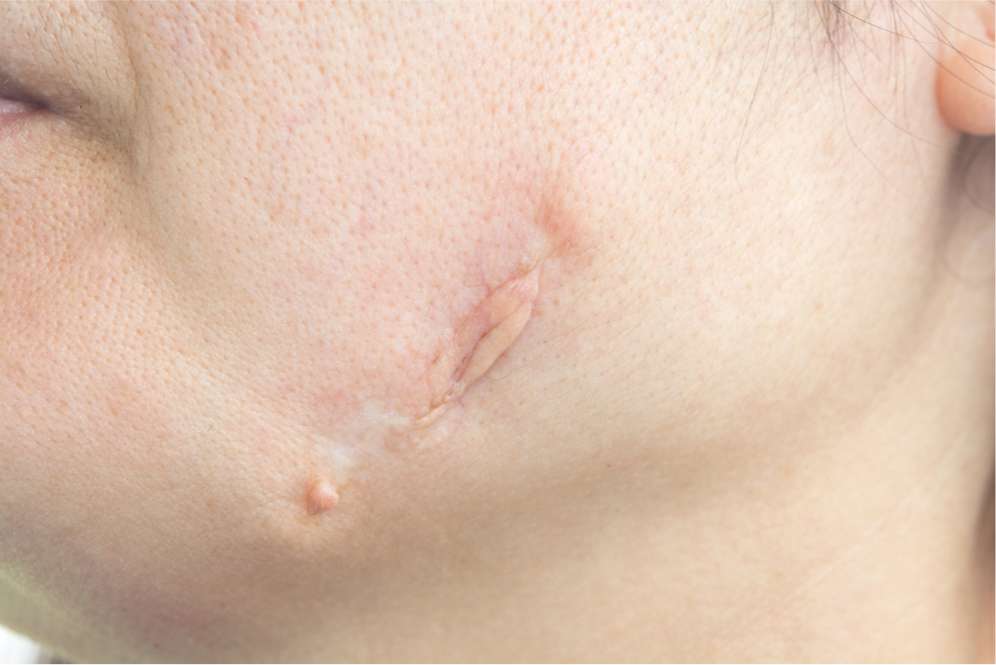Bekas Luka Keloid