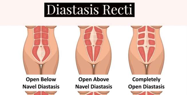 Bisakah Diastasis Dicegah?