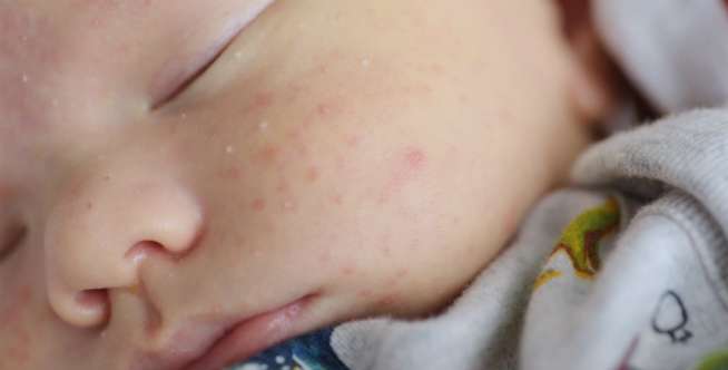 Kulit Bayi Mengelupas? Cari Tahu Cara Merawatnya