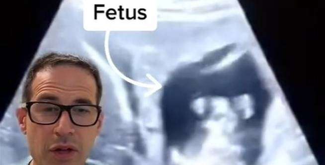 Kasus Langka, Kehamilan Ektopik Terjadi di Liver