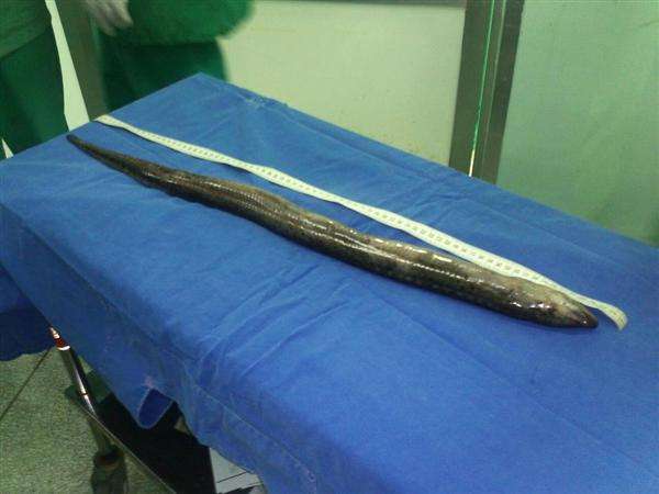 Mengerikan, Belut Sepanjang 125 Cm Hidup di Perut Pria Ini