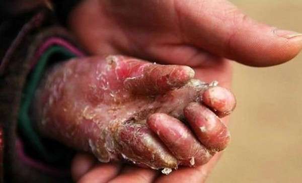 Bocah Ini Dibungkus Tisu karena Derita Penyakit Kulit Langka