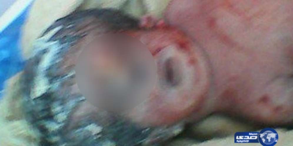 Bayi Bermata Satu di Mesir Meninggal Dunia