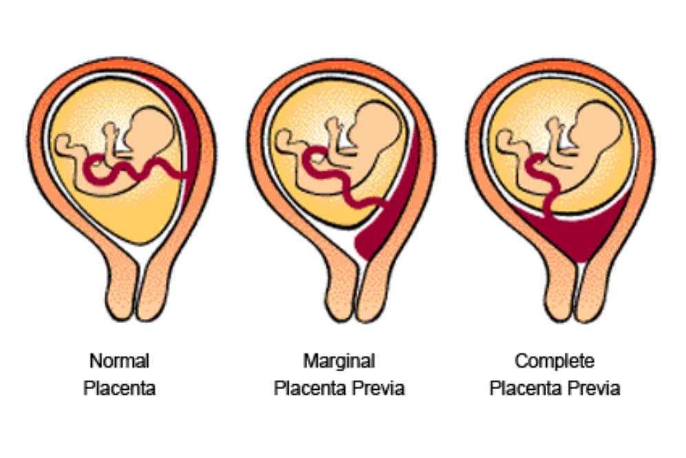Plasenta previa (Foto: Baby Center)