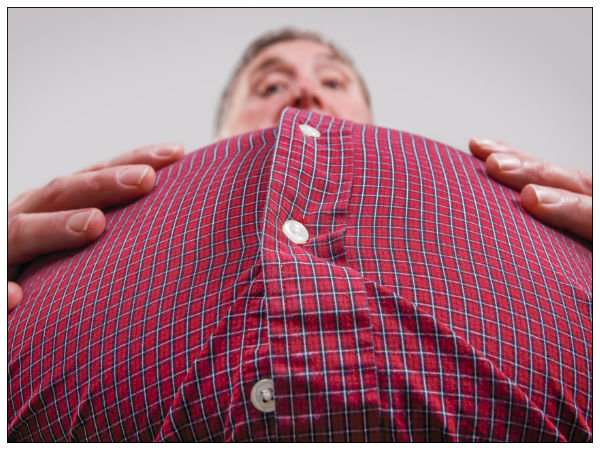 Obesitas