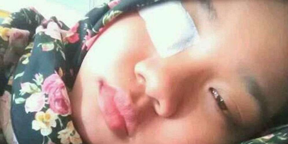 Gadis yang terkena puntung rokok