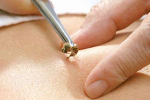 Treantment Kecantikan Ekstrem