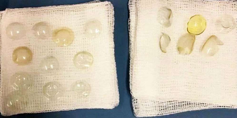27 lensa kontak di mata perempuan tua