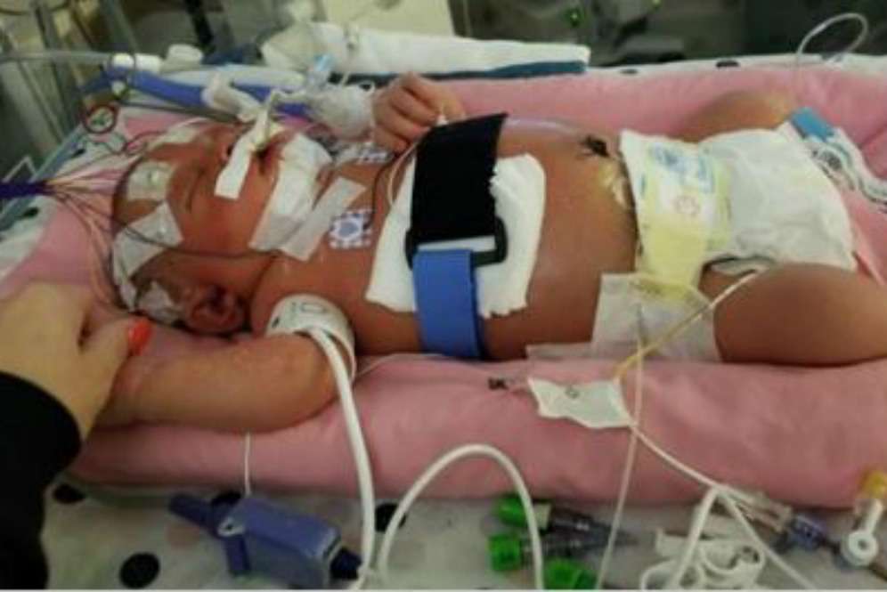 Bayi Mariana dirawat di NICU