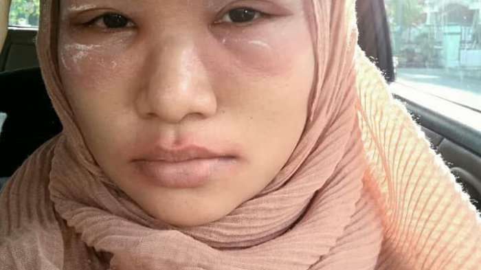 mata bengkak akbat eyeshadow