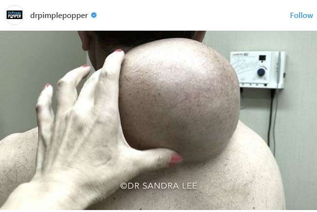 drpimplepopper