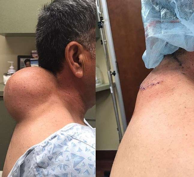 drpimplepopper