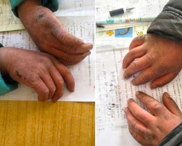Kedinginan Hingga Diserang Frost Bites