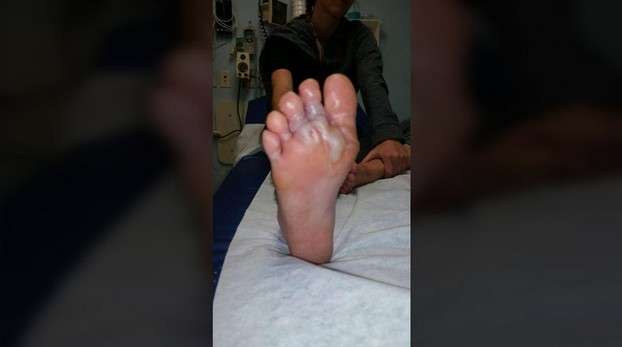 Habis Liburan di Pantai Kaki Bengkak dan Luka Parah 1