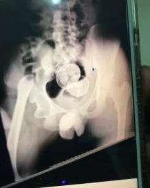 hasil rontgen di tubuh Akmal