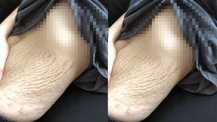 Kondisi perut Doreen Ching yang penuh stretch marks.