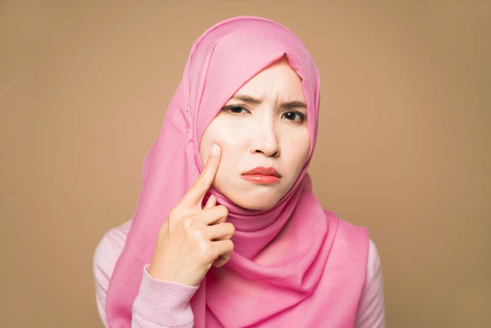 Bekas jerawat bisa timbul karena kebiasaan memencet jerawat yang salah
