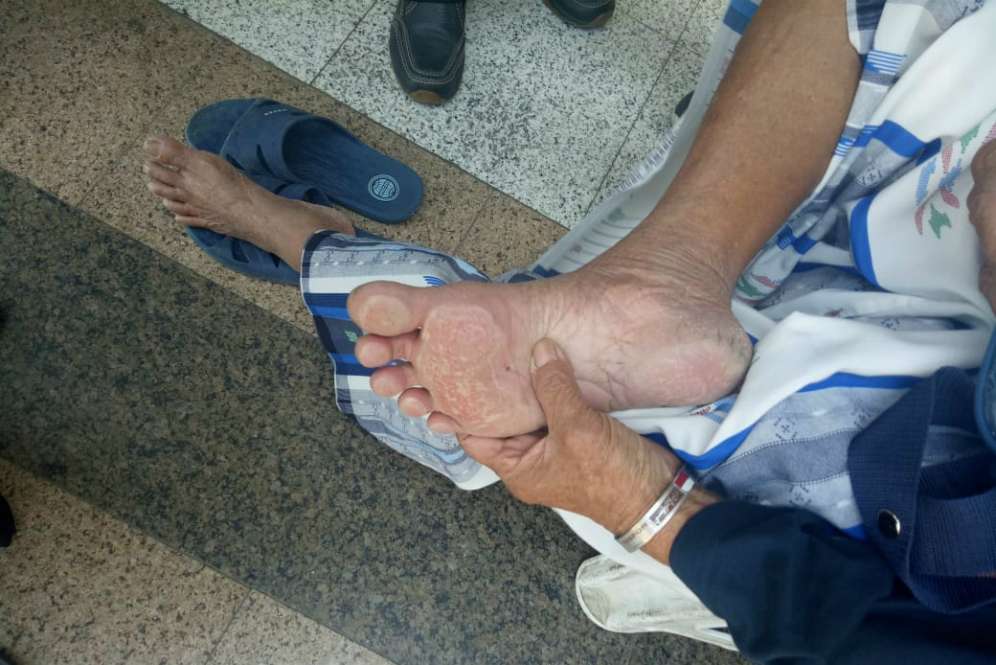 Kaki jemaah haji melepuh karena tidak memakai sandal