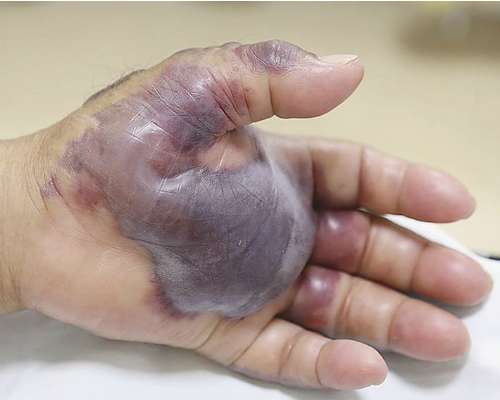 Tangan melepuh akibat makan seafood mentah