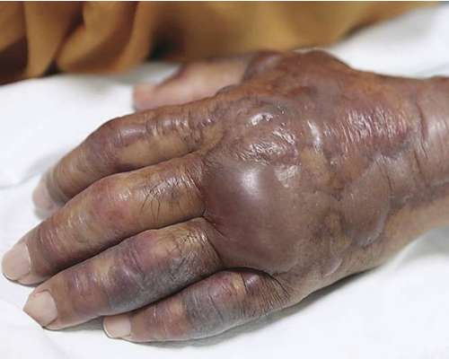 Tangan melepuh akibat makan seafood mentah