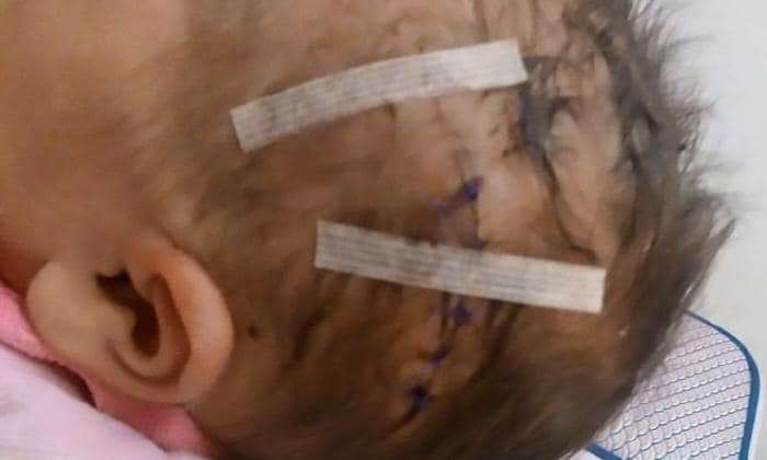 Jahitan di kepala bayi