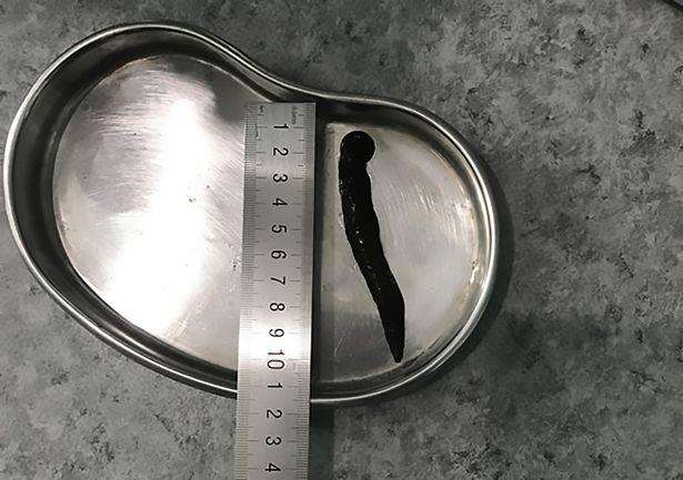 Penampakan lintah sepanjang 10cm yang keluar dari tenggorokan Li.