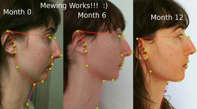 Mewing