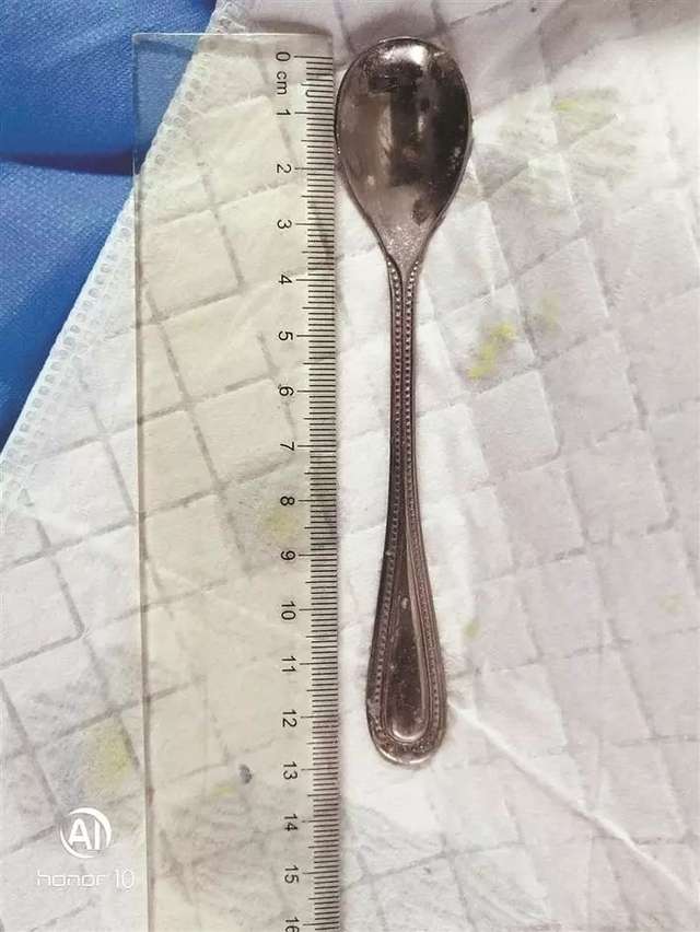 Sendok yang tertelan panjangnya mencapai 13 cm.