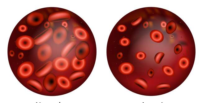Kenali Faktor Anemia Defisiensi Zat Besi pada Wanita