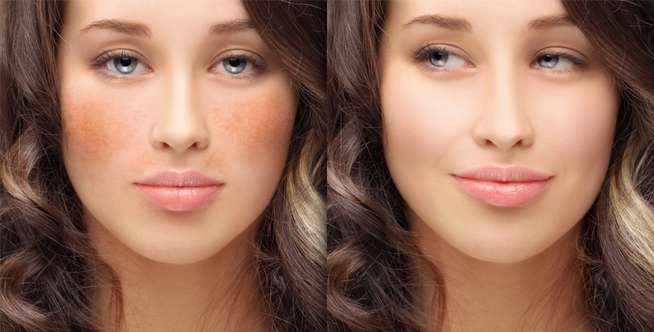 Hyperpigmentation