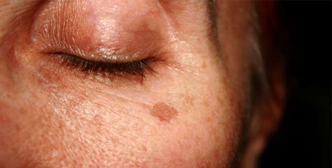 Age Spots