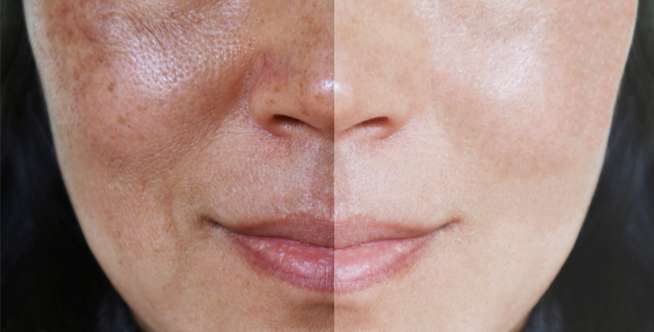 Melasma