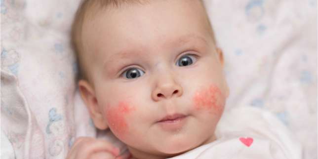 Kulit Kering pada Bayi? Orang Tua Wajib Lakukan Ini